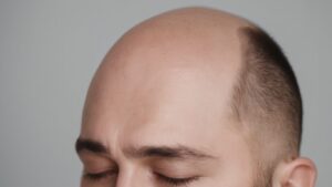 Alopecia Success Using Hypnosis
