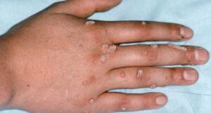 Warts Removed With Hypnotherapy